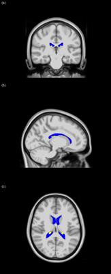 Differences in the choroid plexus volume and microstructure are associated with body adiposity